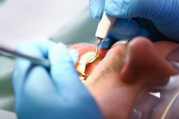Best Knocked-Out Tooth Emergency  in Ocala Estates, FL