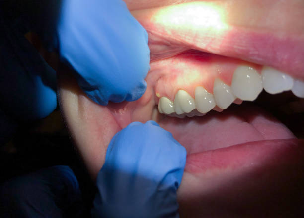 Best Tooth Infection Emergency Dentist  in Ocala Estates, FL